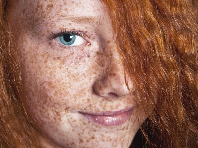 Пігментні плями на шкірі: наскільки небезпечні і як запобігти їх появі?